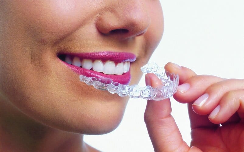 Invisalign